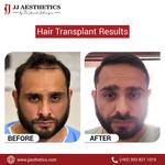 Jj hair transplant clinic in Islamabad - photo 3