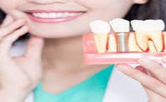 Petal Dental - Dental Implants
