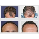 Affordable Hair Transplants Los Angeles - photo 2