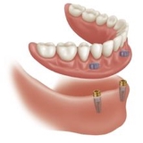 Implant Denture and Dental Center - Other in Fort Lauderdale