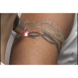 X Tattoo Removal