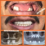 New Teeth Indiana - Other in Dyer