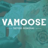 Vamoose Tattoo Removal - Tattoo Removal in Chicago