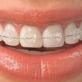 Designer Braces in Brooklyn - Dentists in New York