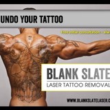 Blank Slate Laser Tattoo Remvl - Tattoo in Houston