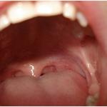 Wisdom Teeth Removal - photo 3