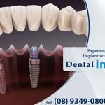 Dental Implant in Balcatta Perth - Dentist in Perth - All on 4 Dental Implant - photo 1