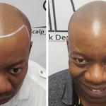 Scalp Ink Design - Scalp Micropigmentation - photo 2