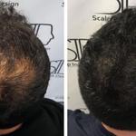 Scalp Ink Design - Scalp Micropigmentation - photo 3