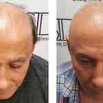 Scalp Ink Design - Scalp Micropigmentation - photo 5
