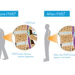 Mild Procedure California - photo 1