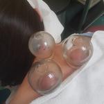 Ombright Wellness Acupuncture -Mobile Acupuncture Therapy - photo 5