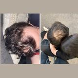 Hair Transplant Melbourne - Hair Removal in Melbourne