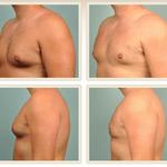 Tummy tuck cost in Lahore - photo 5
