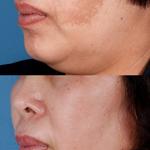 JoAnn Francis Fillers - photo 2