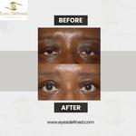 blepharoplasty London Before and After - photo 1