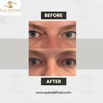 blepharoplasty London Before and After - photo 2