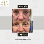 blepharoplasty London Before and After - photo 3