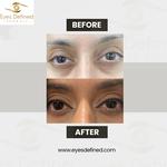 blepharoplasty London Before and After - photo 4