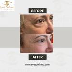 blepharoplasty London Before and After - photo 5