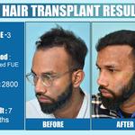 Dermalife - Best Dermatology | Hair Transplant Clinic in Delhi - photo 4