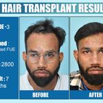 Dermalife - Best Dermatology | Hair Transplant Clinic in Delhi - photo 5