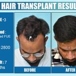 Dermalife - Best Dermatology | Hair Transplant Clinic in Delhi - photo 6