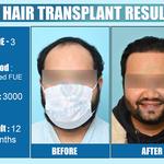 Dermalife - Best Dermatology | Hair Transplant Clinic in Delhi - photo 7