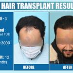 Dermalife - Best Dermatology | Hair Transplant Clinic in Delhi - photo 10