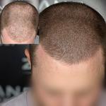Zang SMP - Scalp Micropigmentation Orange County - photo 1