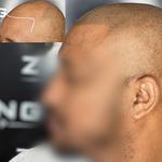 Zang SMP - Scalp Micropigmentation Orange County - photo 4