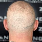Zang SMP - Scalp Micropigmentation Orange County - photo 5