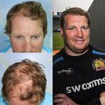 Capital Hair Restoration - Hair Transplant - photo 2