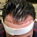 Capital Hair Restoration - Hair Transplant - photo 3