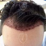 Capital Hair Restoration - Hair Transplant - photo 4