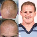 Capital Hair Restoration - Hair Transplant - photo 5