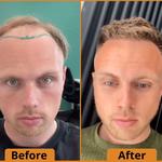 Capital Hair Restoration - Hair Transplant - photo 7