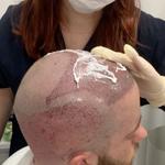Capital Hair Restoration - Hair Transplant - photo 8