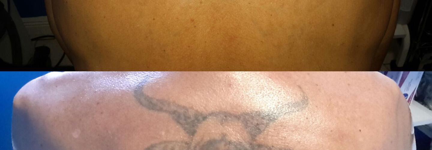 Winter Park Tattoo Removal cover photo
