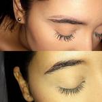 Winter Park Tattoo Removal - photo 1