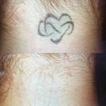 Winter Park Tattoo Removal - photo 2