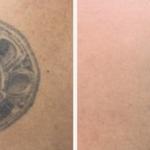 Pocatello Tattoo Removal - photo 1