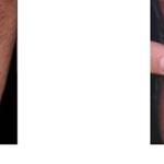 Lipoma Removal Cost London - Lipoma Removal Clinic - photo 1