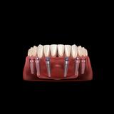 Clínica Dental Tapias | Dentista en Alcorcón - Dental Implants in Alcorcon