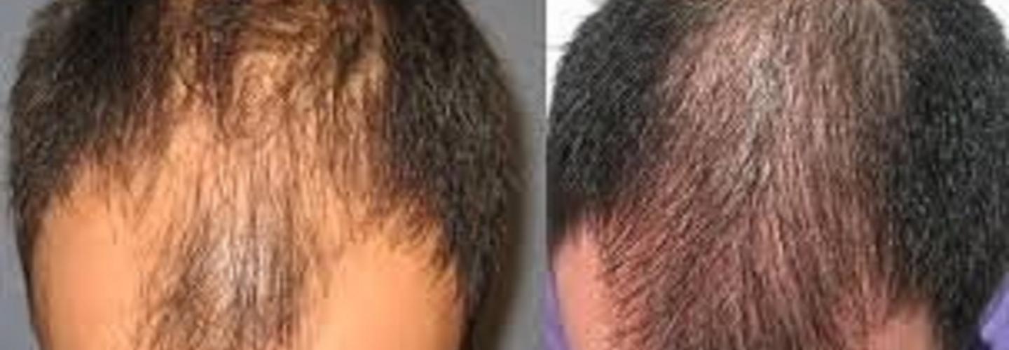 PRP Hair Loss Treatment cover photo
