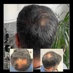 Capital Hair Restoration - Hair Transplant - photo 2
