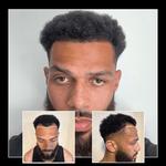 Capital Hair Restoration - Hair Transplant - photo 3