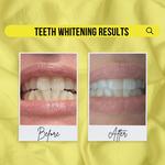 Brighter Smiles Cosmetic Teeth Whitening - photo 2