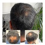 Capital Hair Restoration - Hair Transplant - photo 1