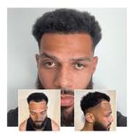 Capital Hair Restoration - Hair Transplant - photo 2